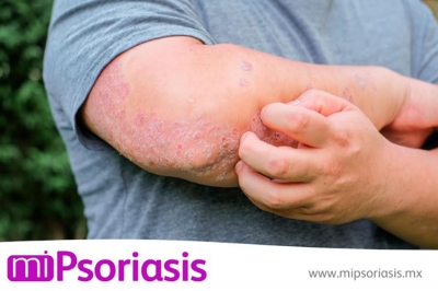 Nueva campaña nacional busca crear conciencia sobre la psoriasis, derribar mitos y presentar innovadoras opciones de tratamiento